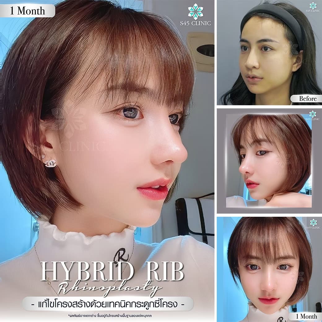 แก้ไขโครงสร้างจมูก
