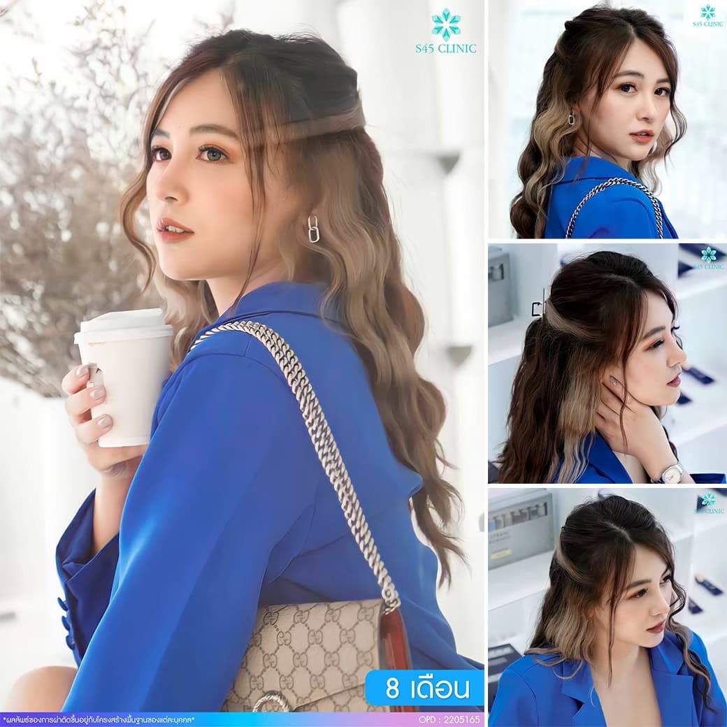 รีวิวแก้จมูก หมอบิ๊ก
