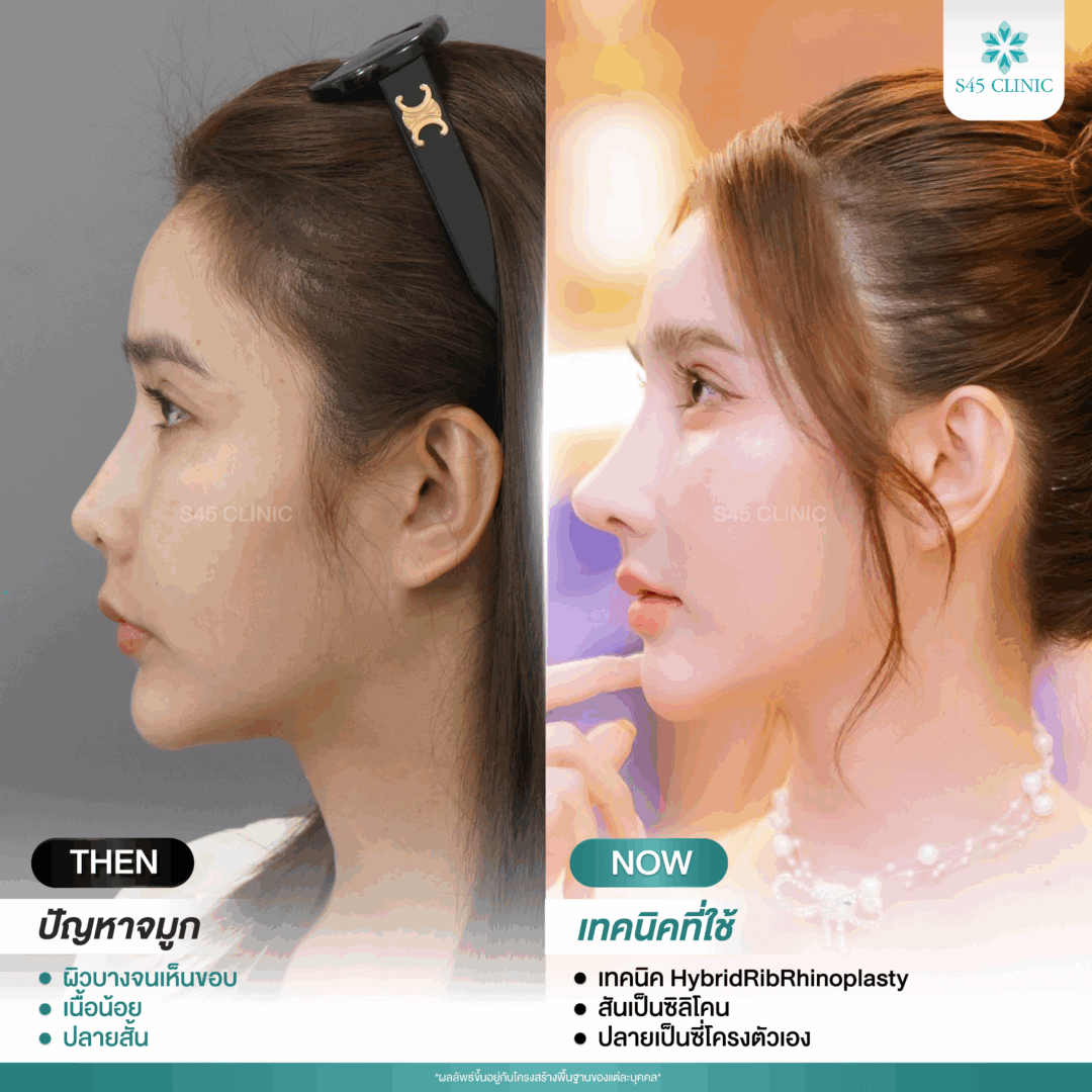 รีวิวแก้จมูก หมอบิ๊ก
