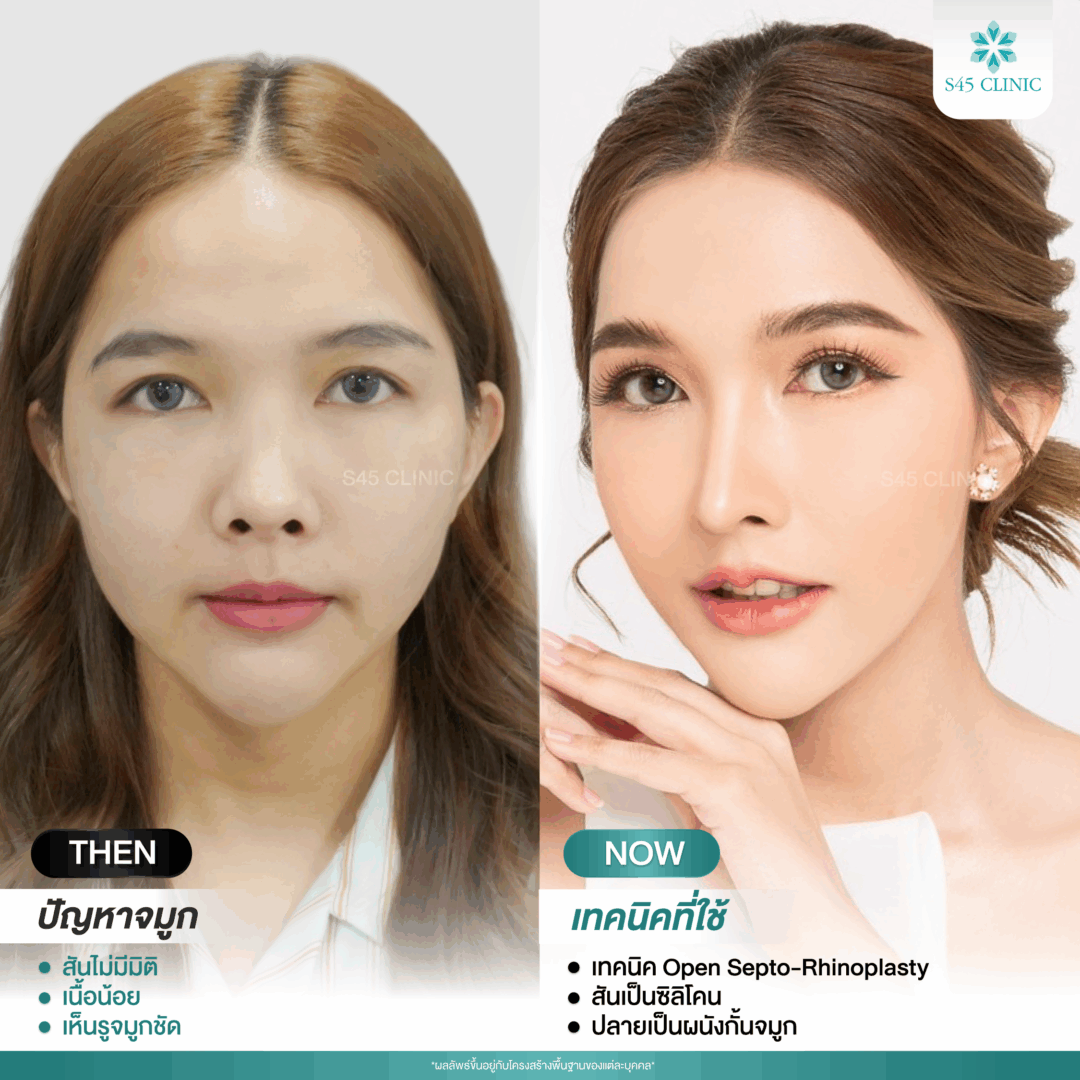 รีวิวแก้จมูก หมอบิ๊ก