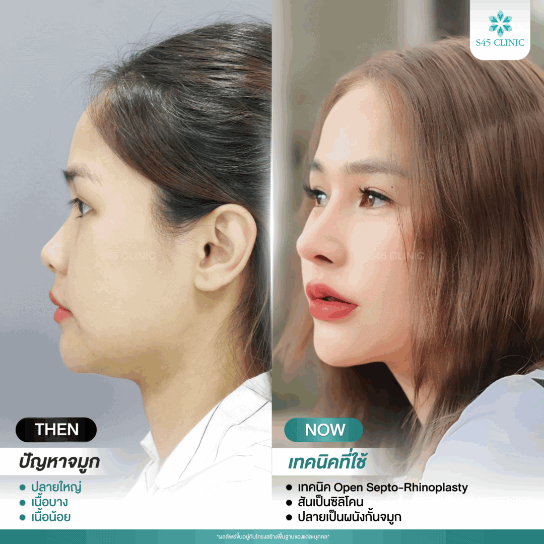 รีวิวแก้จมูก หมอบิ๊ก