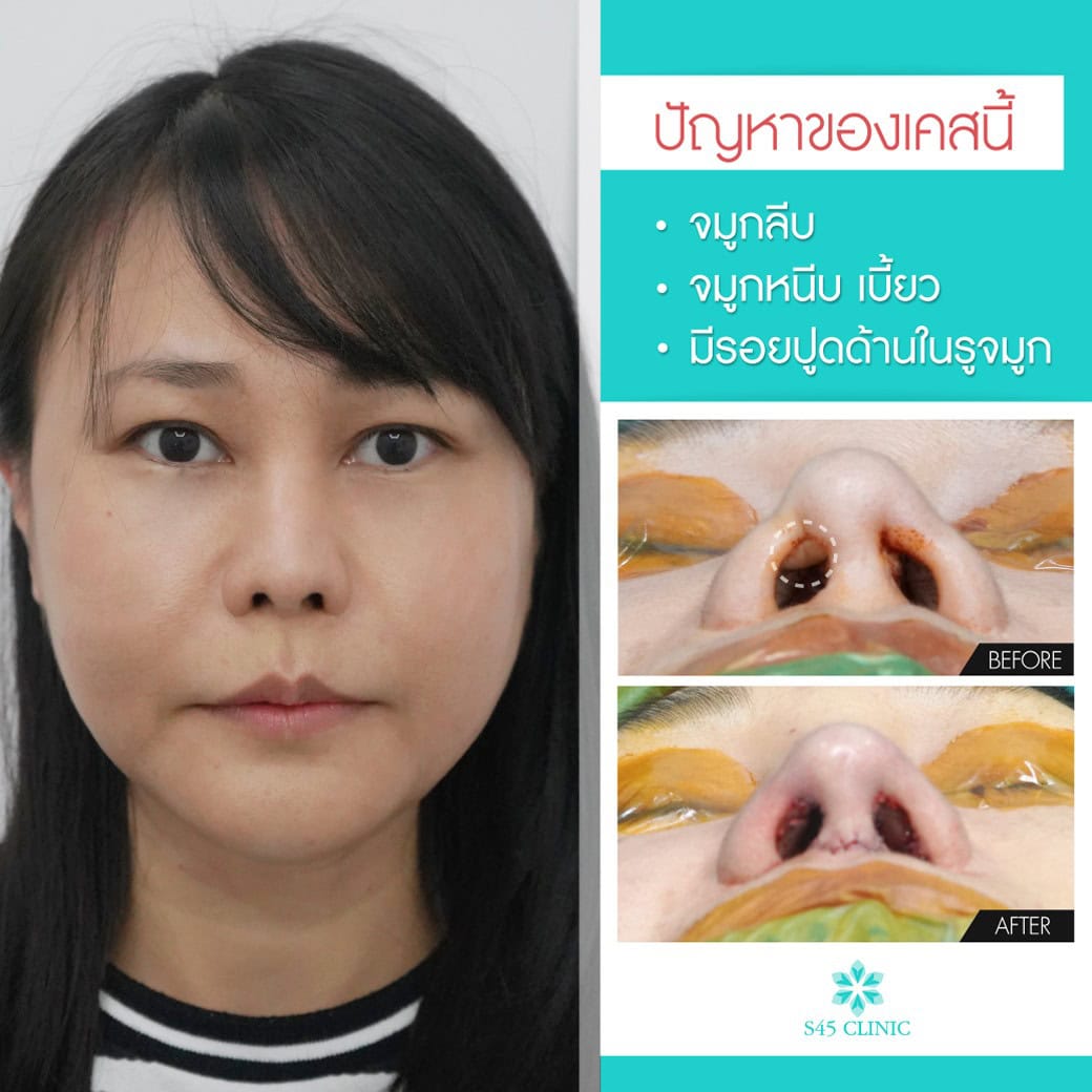 เคสยาก 3 - s45 clinic