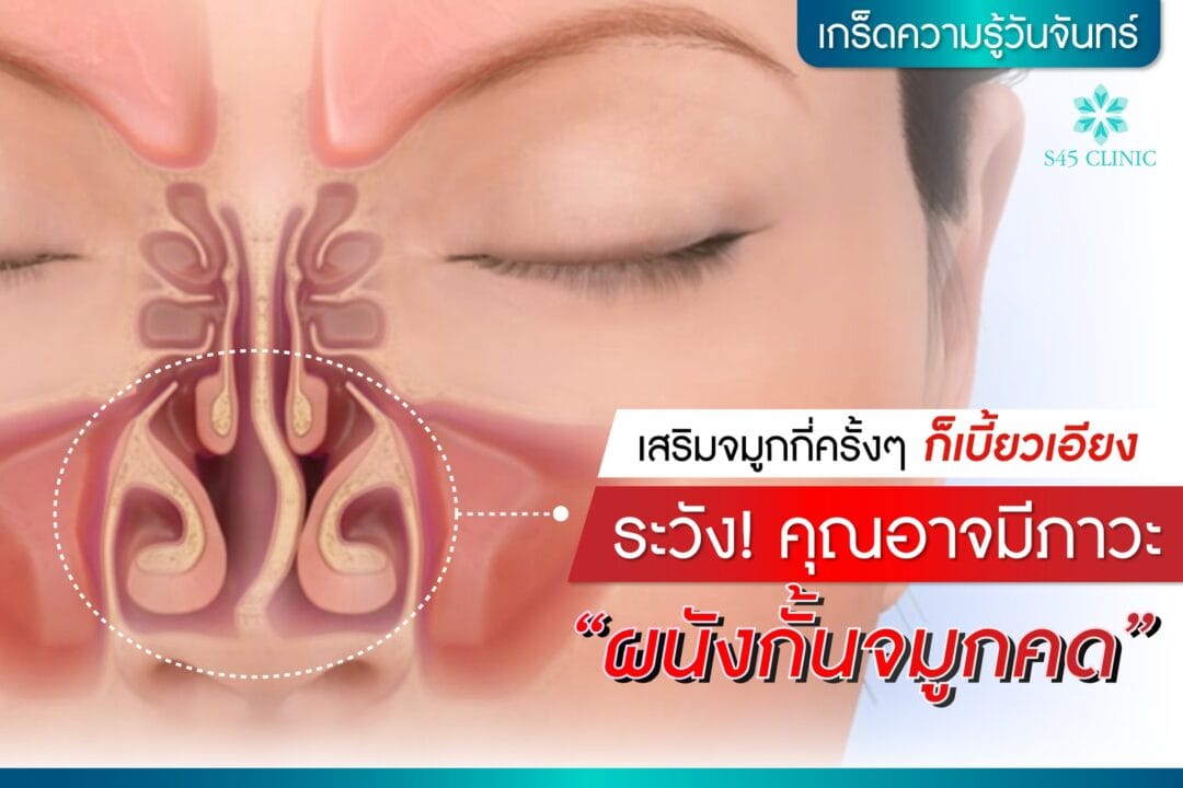 ผนังกั้นจมูกคด