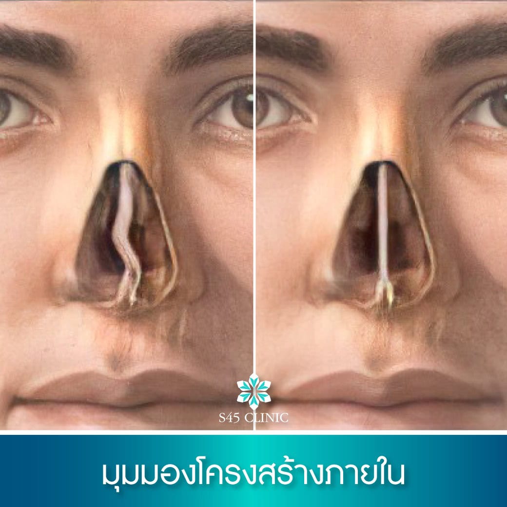 ผนังกั้นจมูกคด