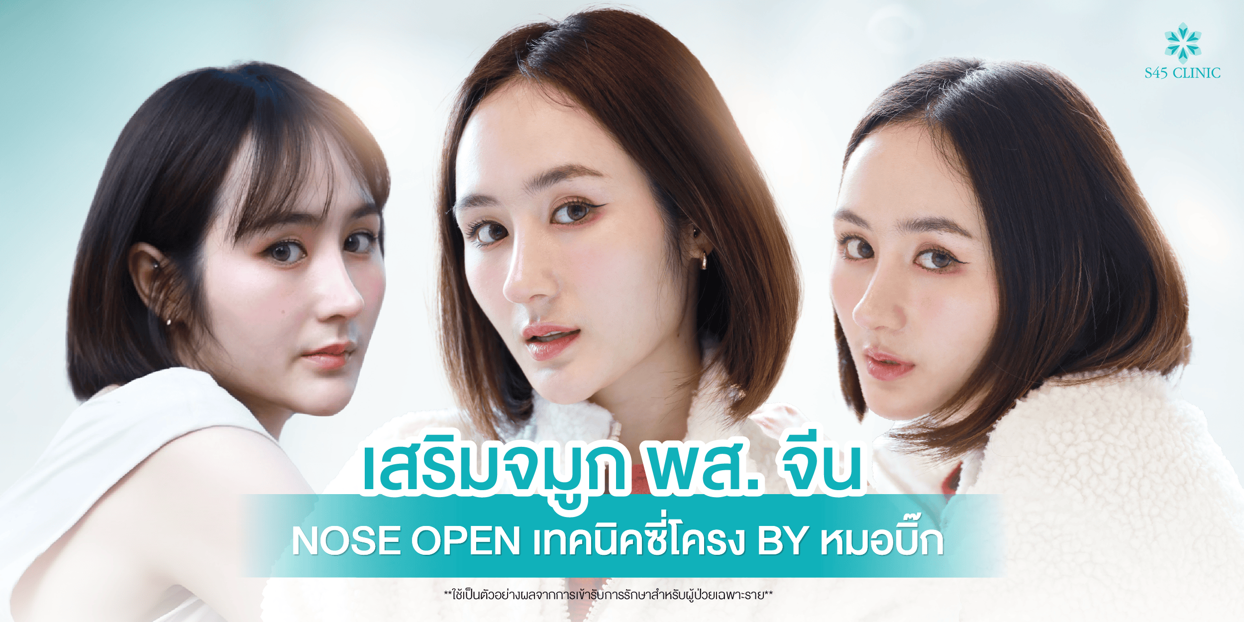 ทรงจมูก พส. จีน