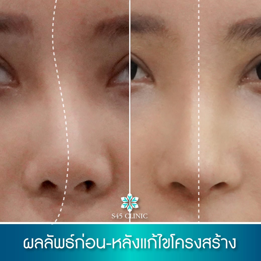 ผนังกั้นจมูกคด