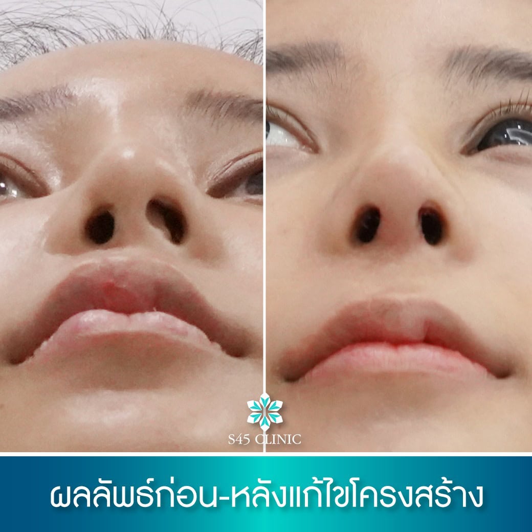 ผนังกั้นจมูกคด