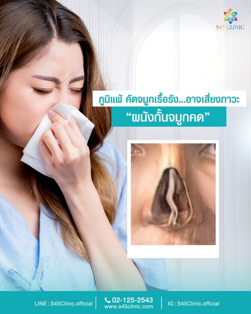 ผนังกั้นจมูกคด