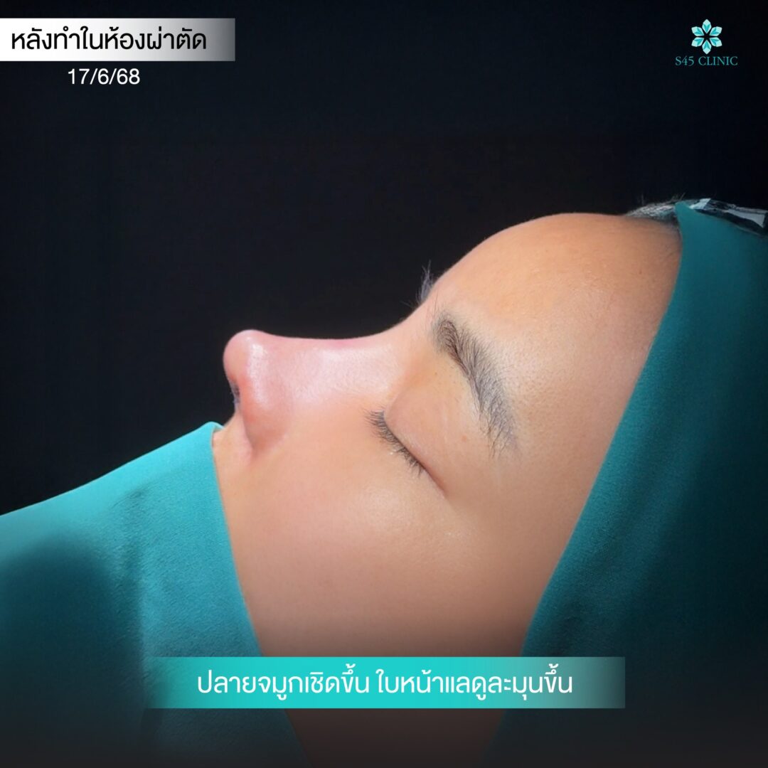 เสริมจมูก พส.จีน โดยหมอบิ๊ก