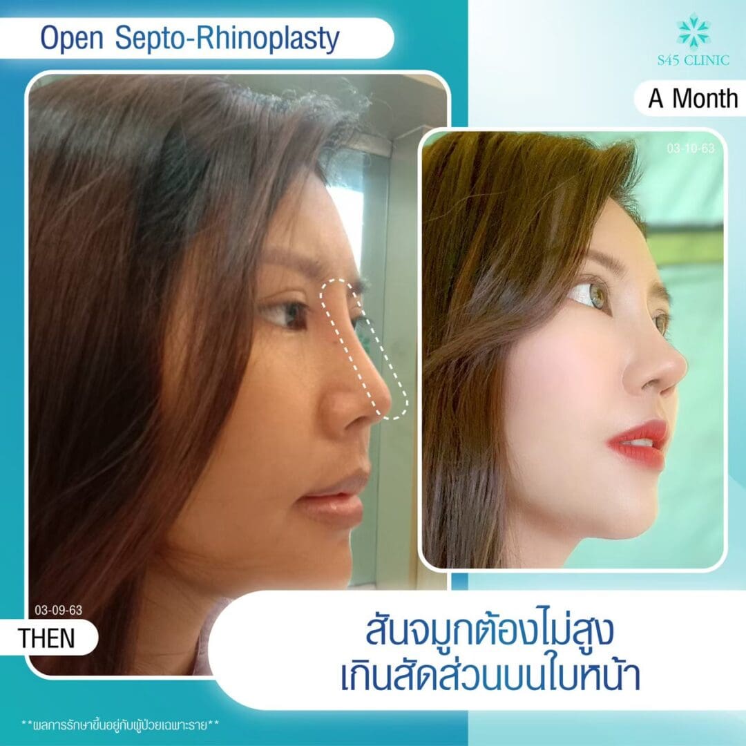 เสริมจมูกแล้วซิลิโคนลอย ควรทำอย่างไร? 6 แก้จมูก