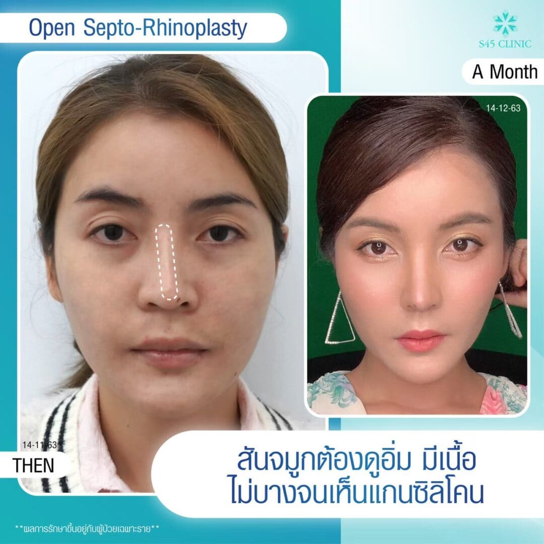 เสริมจมูกแล้วซิลิโคนลอย ควรทำอย่างไร? 5 แก้จมูก