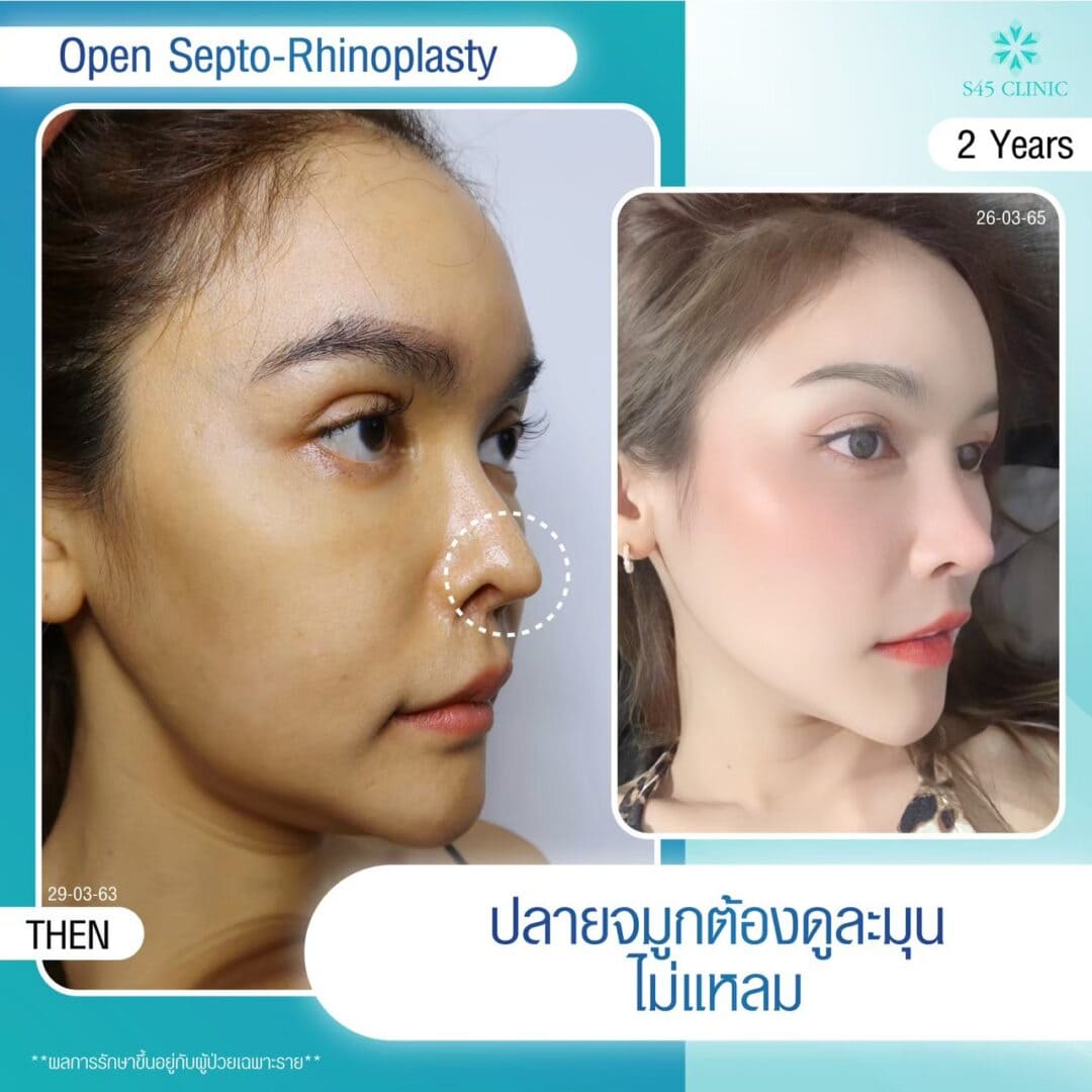 เสริมจมูกแล้วซิลิโคนลอย ควรทำอย่างไร? 4 แก้จมูก