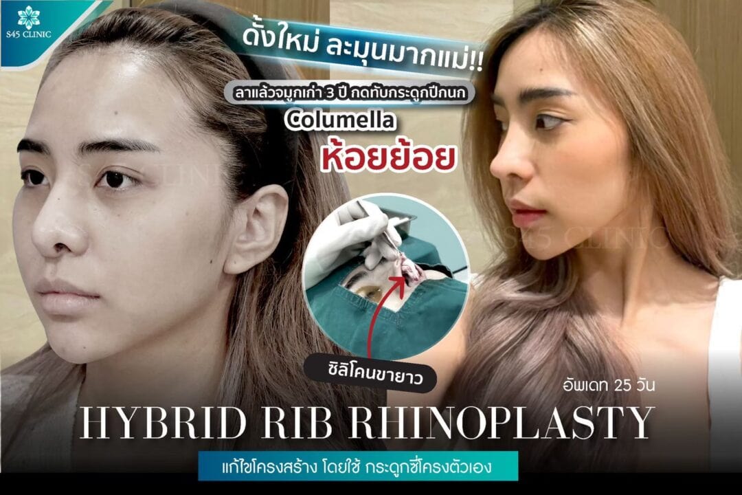 แก้จมูก ซิลิโคนยาว