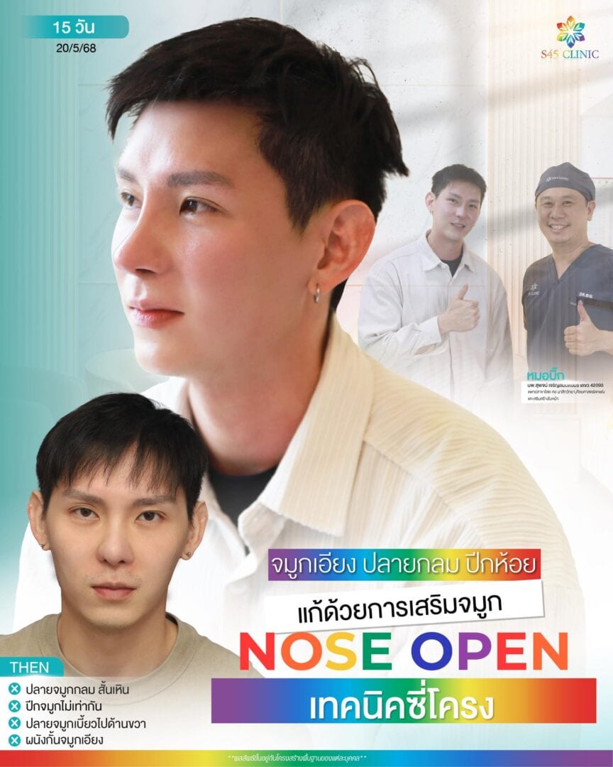 เสริมจมูกผู้ชาย เทคนิคโอเพ่น + ซี่โครง