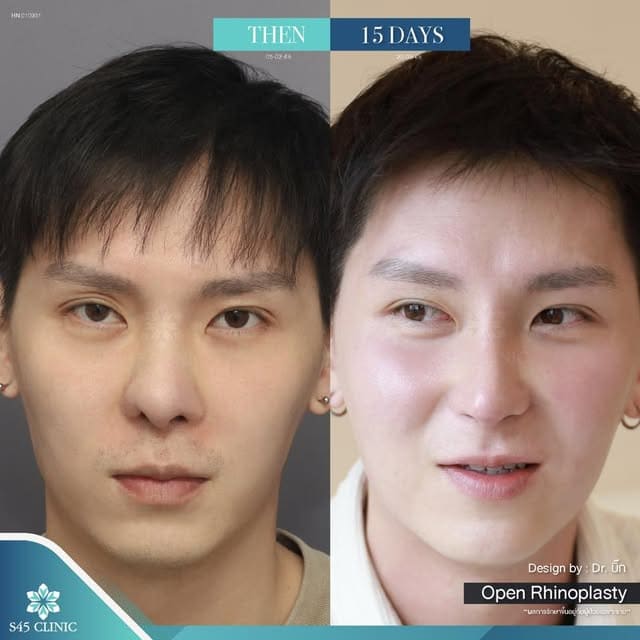 เสริมจมูกผู้ชาย เทคนิคโอเพ่น + ซี่โครง