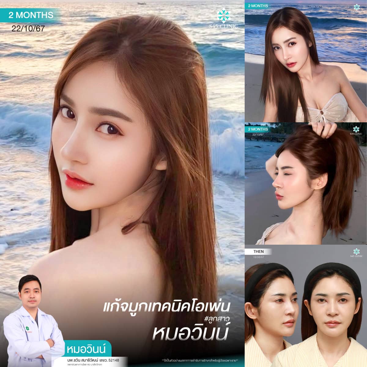 แก้จมูก หมอวินน์