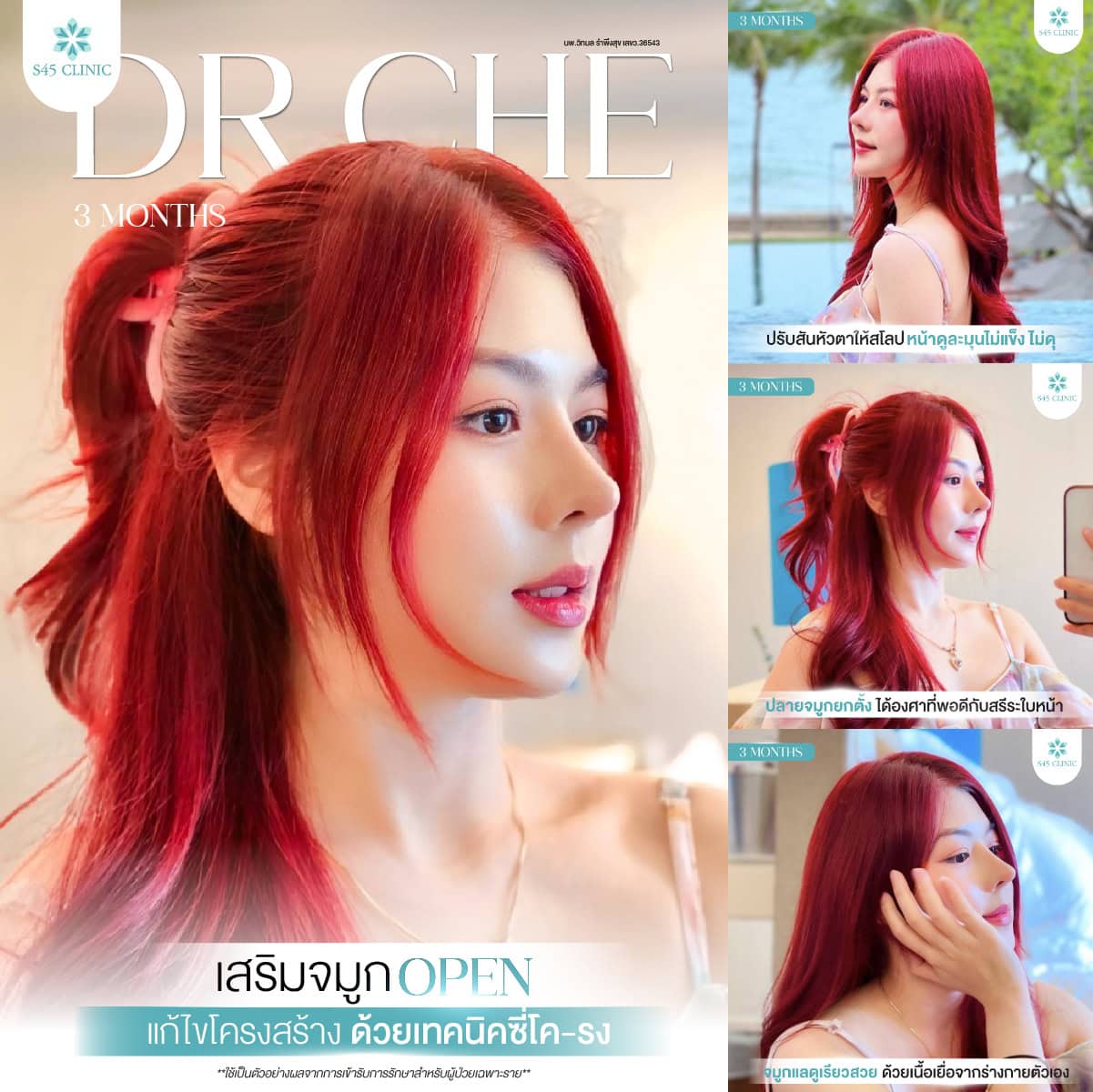 แก้จมูก แก้ไขโครงสร้างด้วยซี่โครง