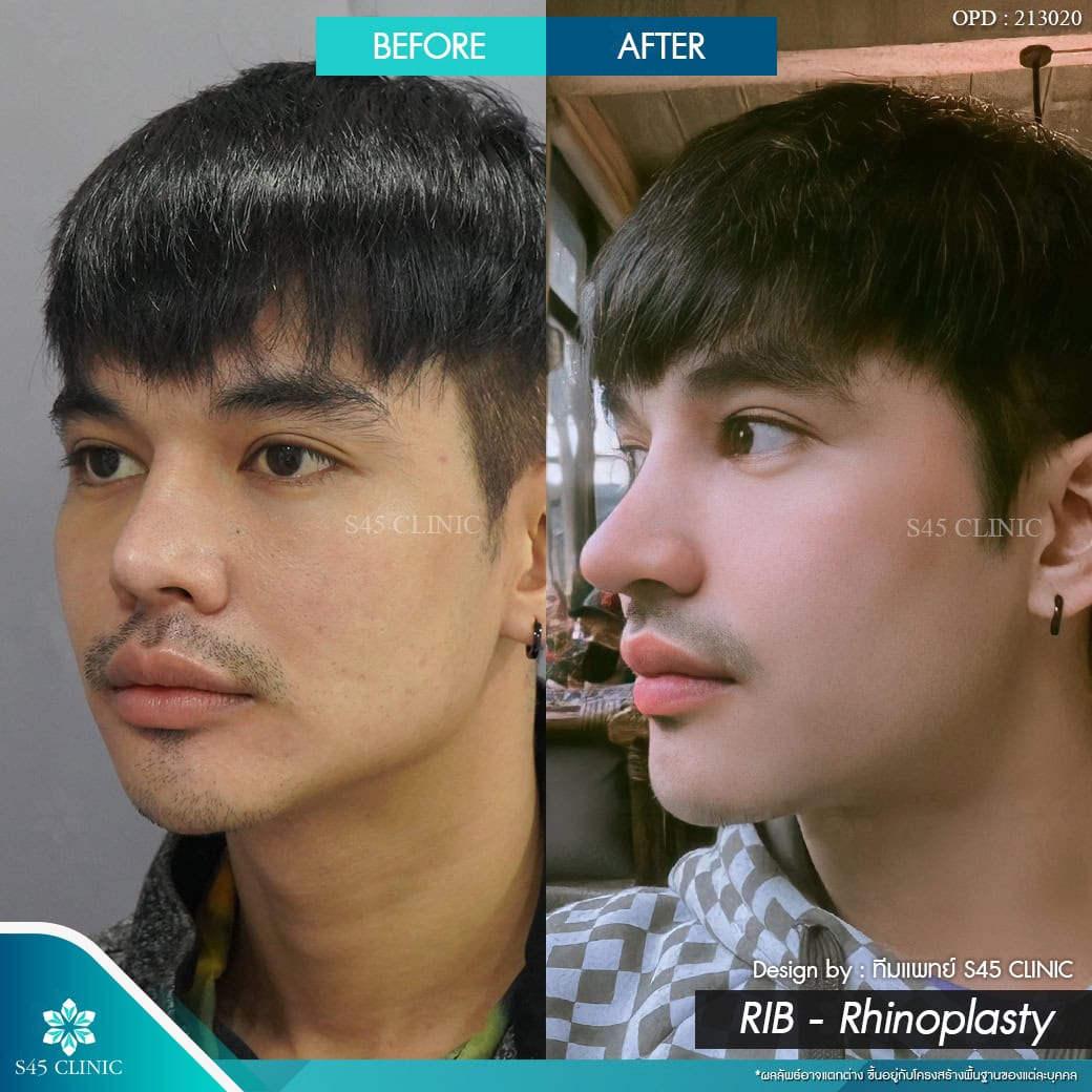 เสริมจมูก ผู้ชาย