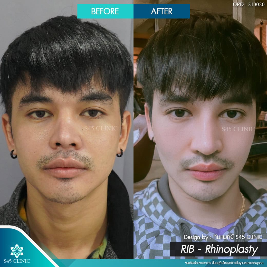 เสริมจมูก ผู้ชาย