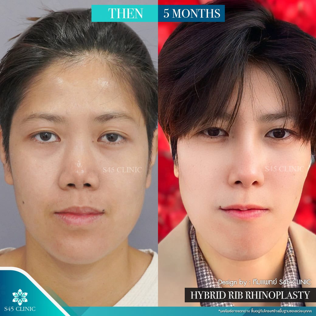 เสริมจมูก ผู้ชาย