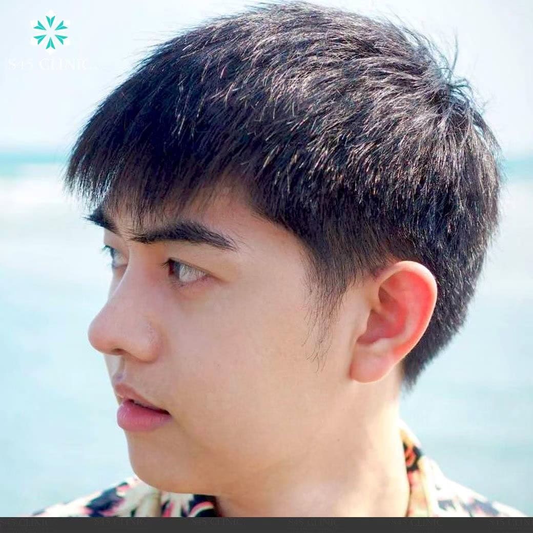เสริมจมูก ผู้ชาย