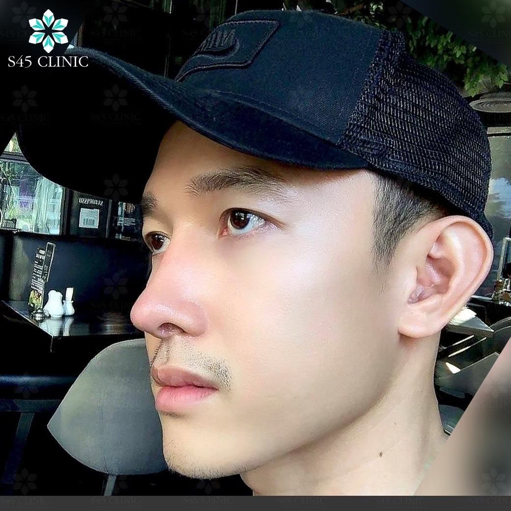 เสริมจมูก ผู้ชาย