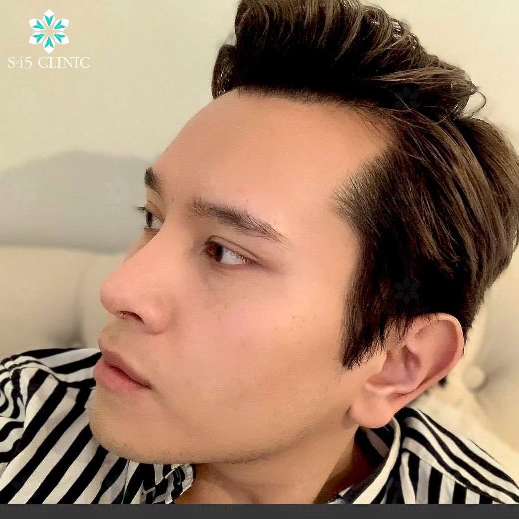 เสริมจมูก ผู้ชาย