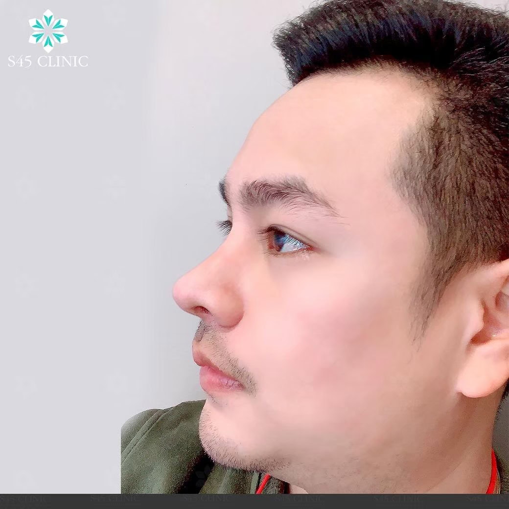 เสริมจมูก ผู้ชาย