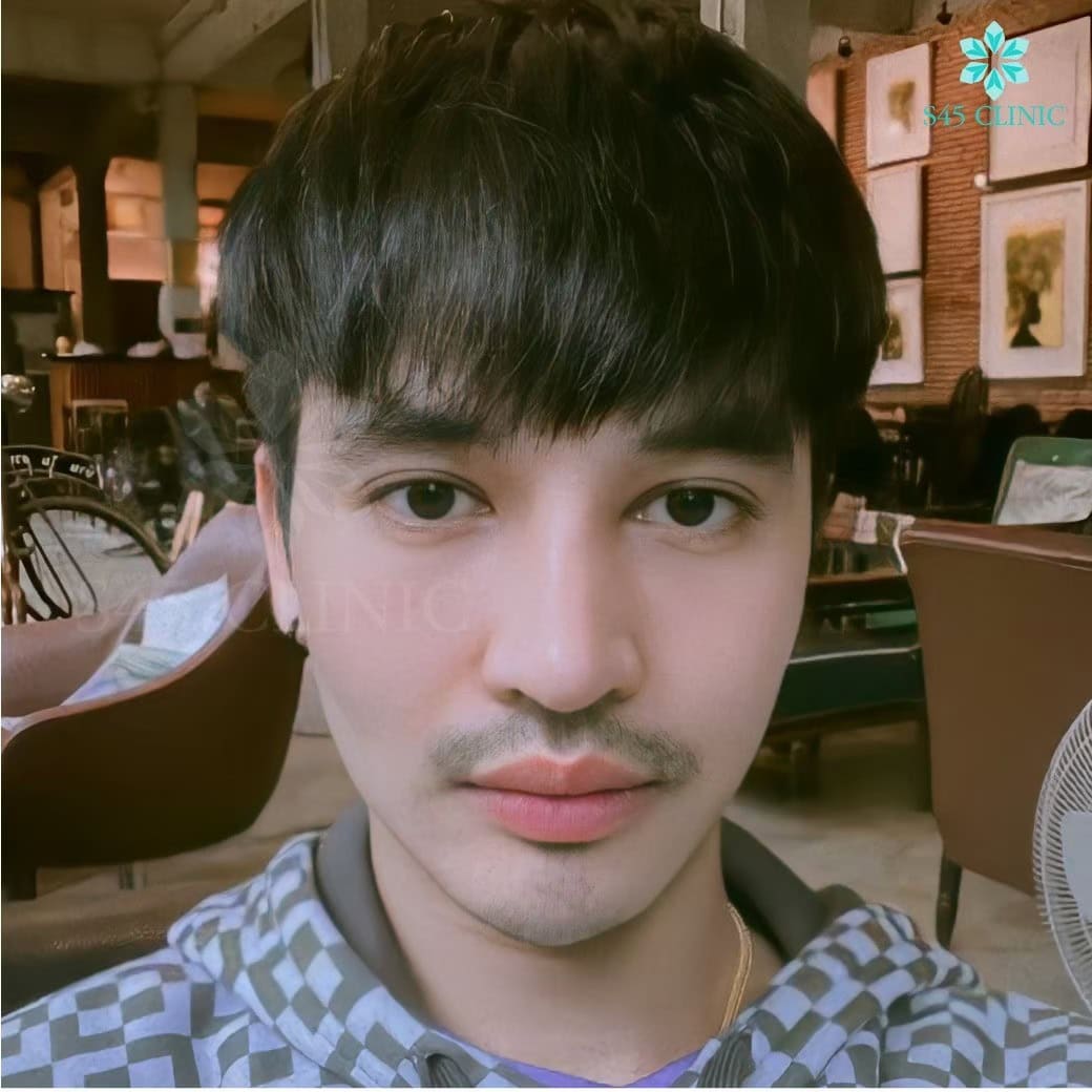 เสริมจมูก ผู้ชาย