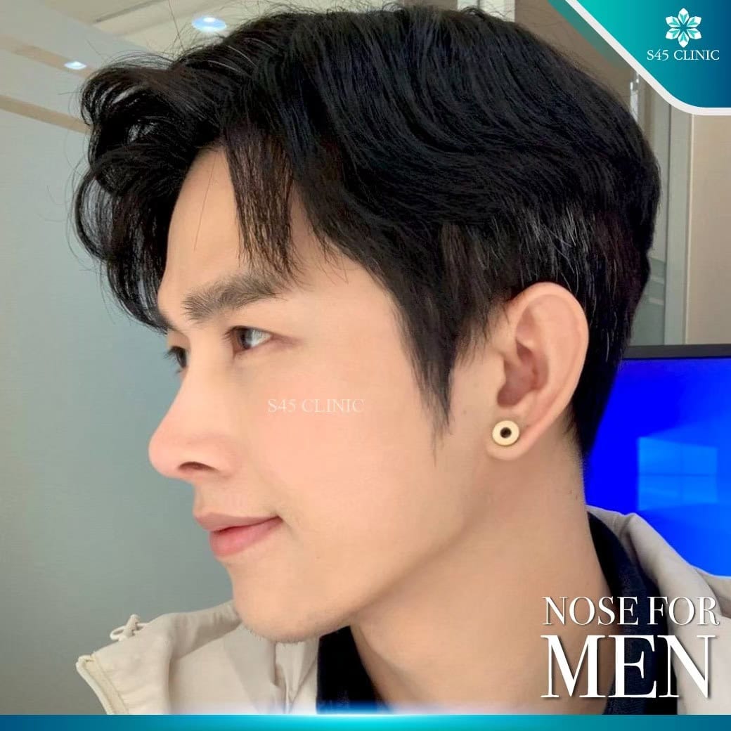 เสริมจมูก ผู้ชาย