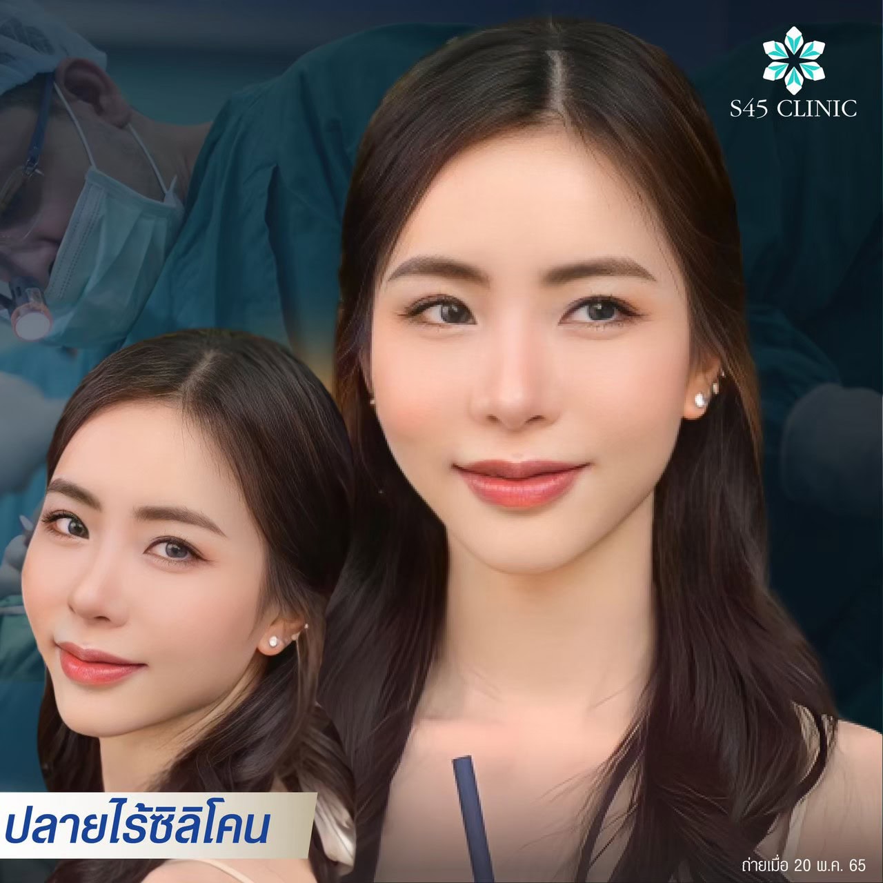 เสริมจมูกปลายไร้ซิลิโคน