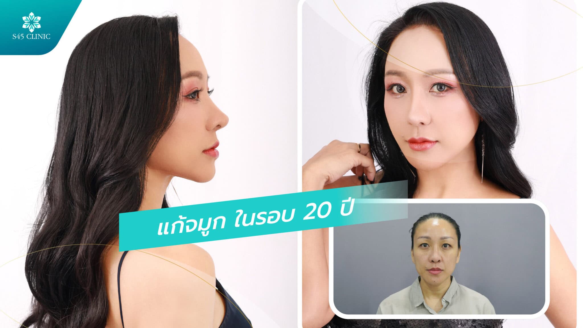 แก้จมูก หมอเช