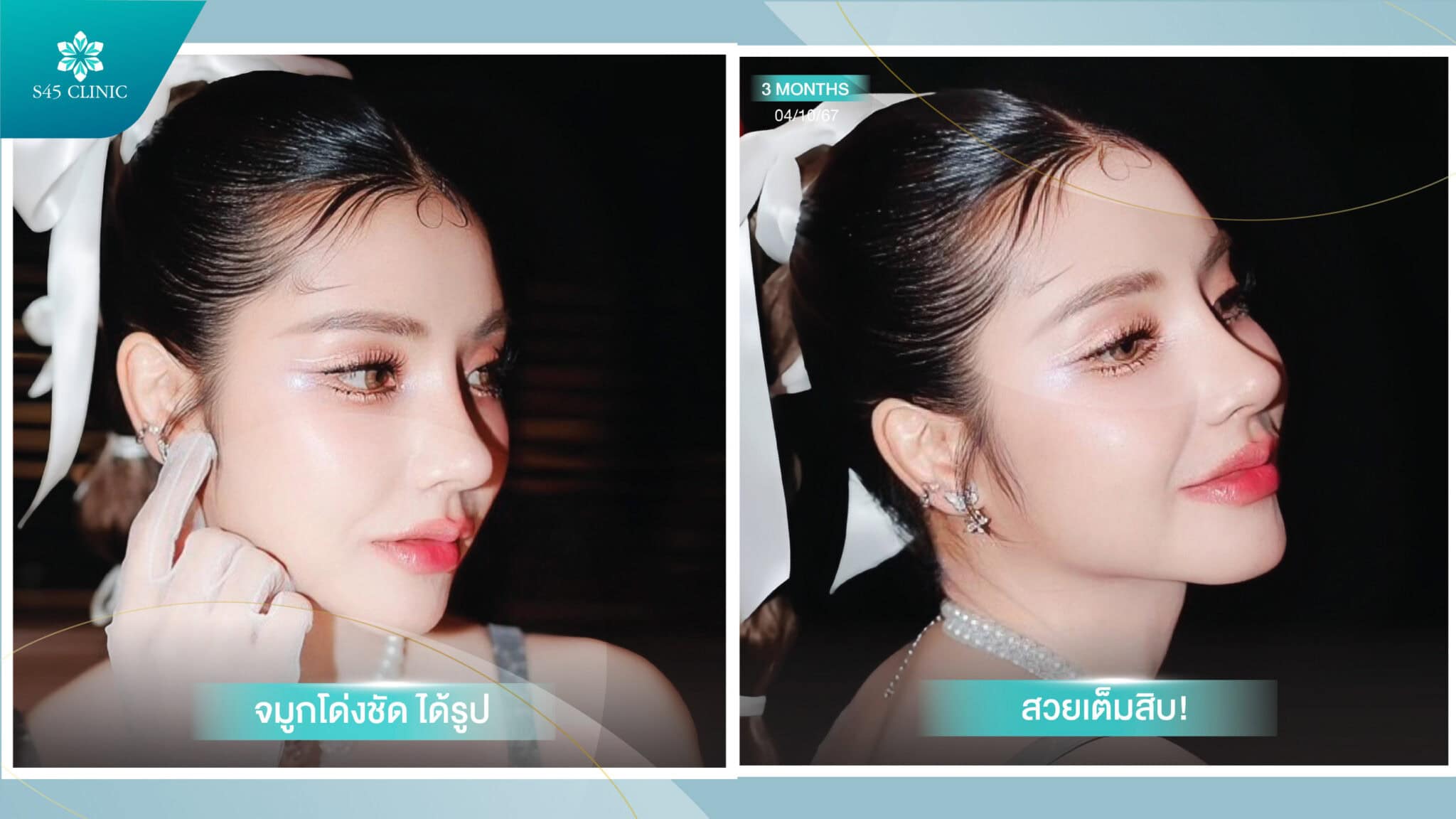 เสริมจมูก ราคา