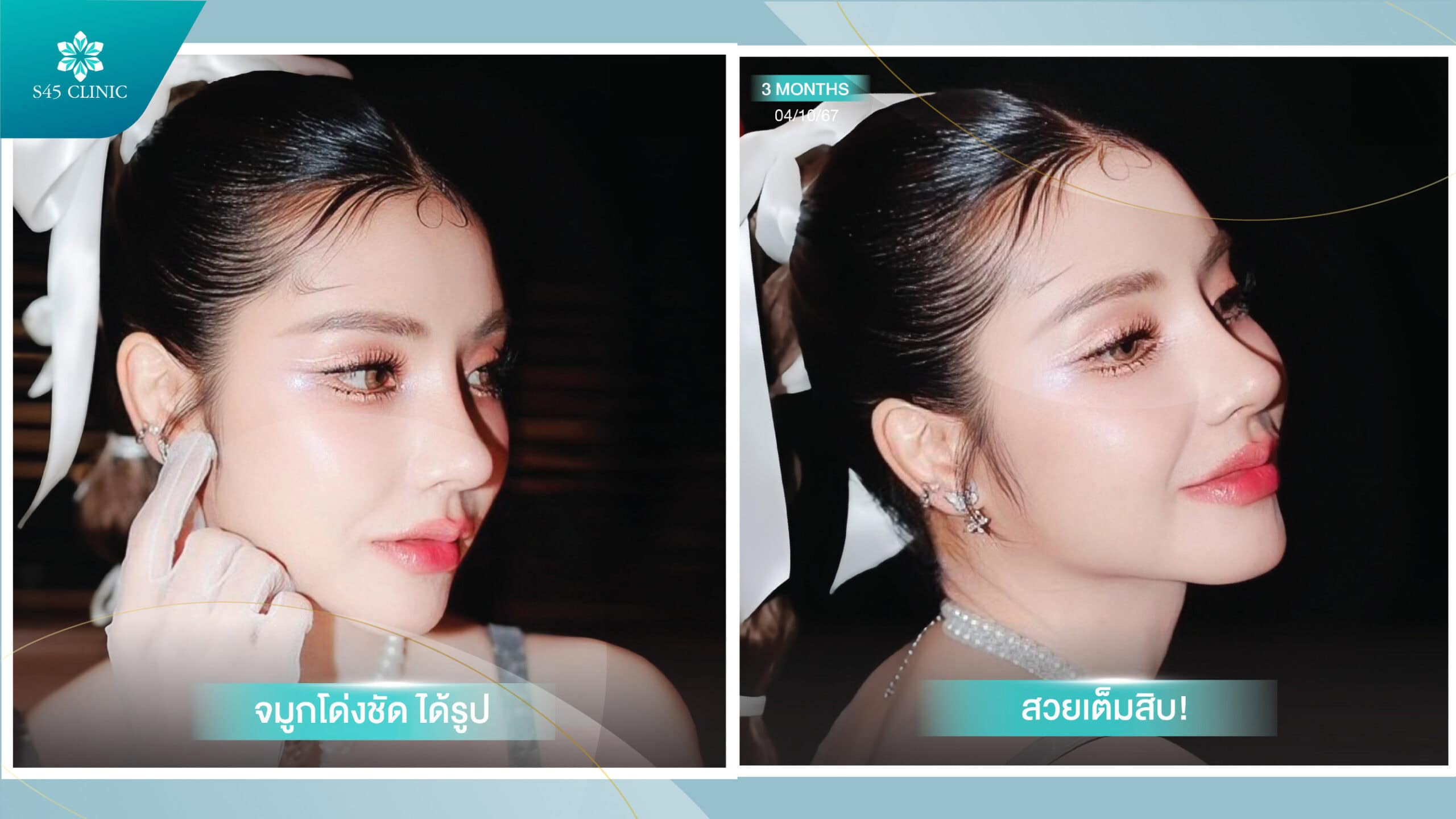 เสริมจมูก ราคา