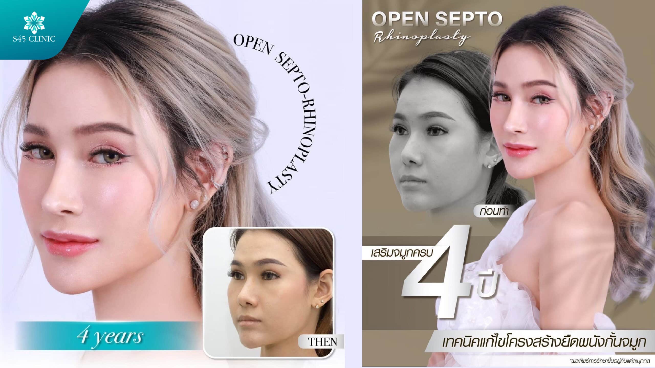ทำยังไงให้ลดบวมได้ไว