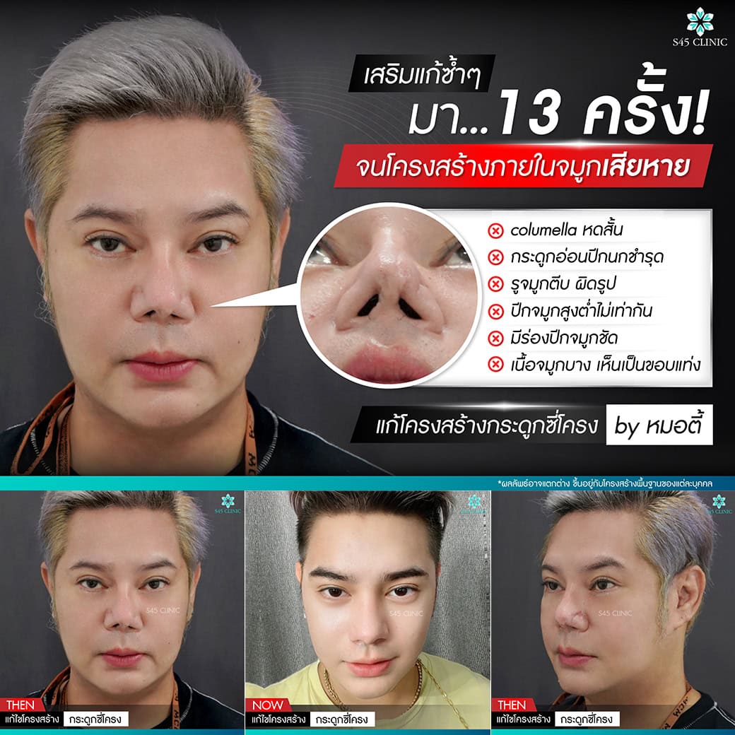 แก้จมูก เสริมจมูกผู้ชาย