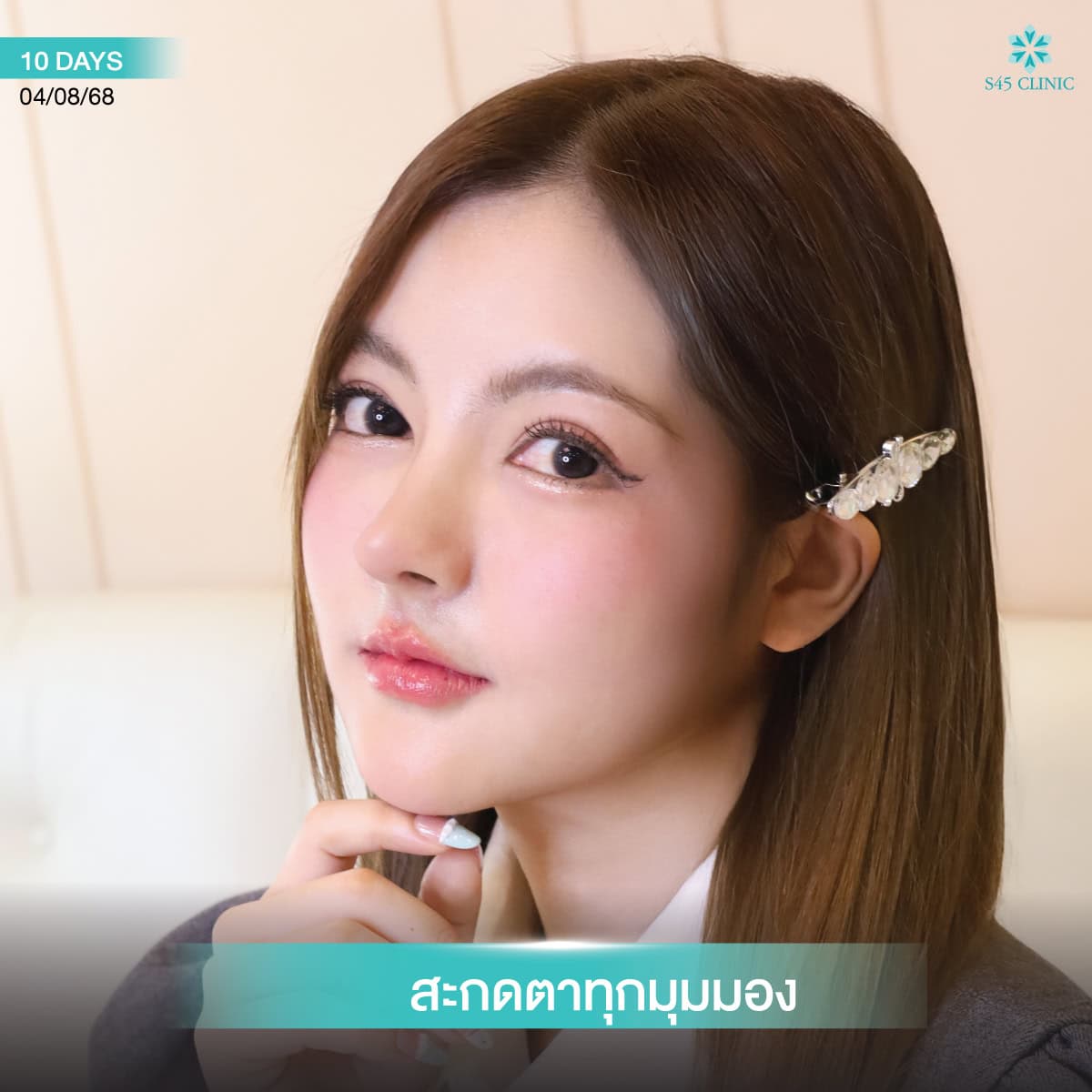 b-nose หมอบิ๊ก