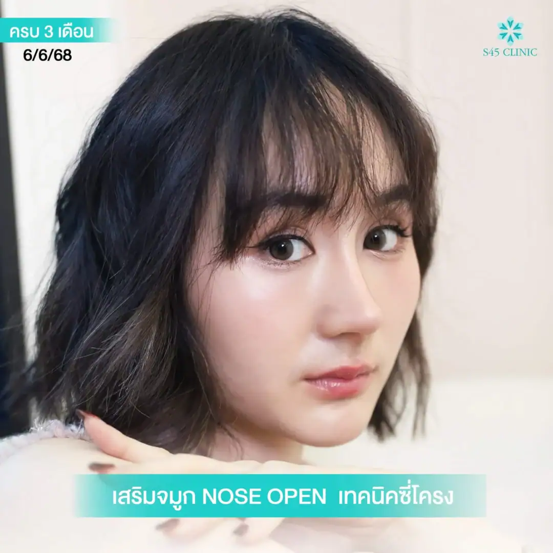 เสริมจมูก B-nose
