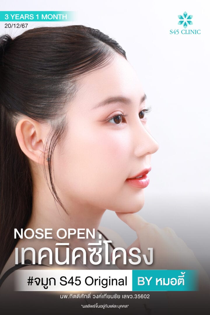 แก้จมูก หมอตี้