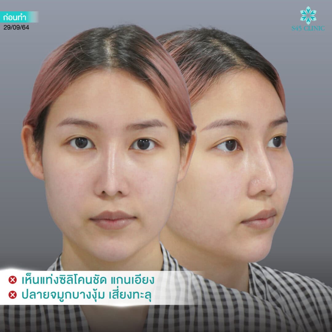 แก้จมูก หมอตี้