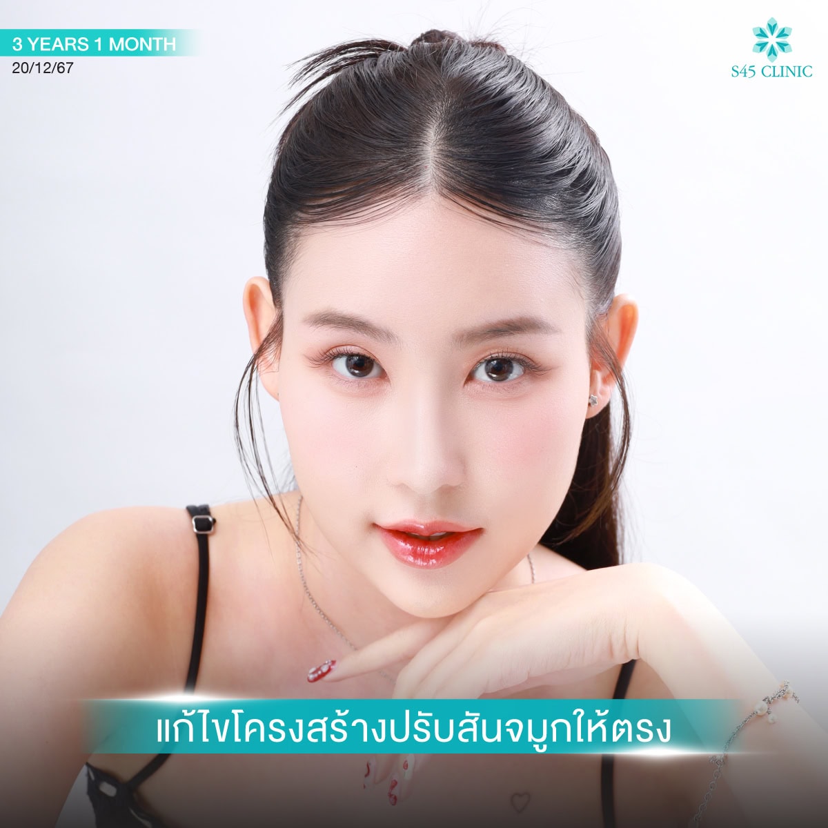แก้จมูก หมอตี้