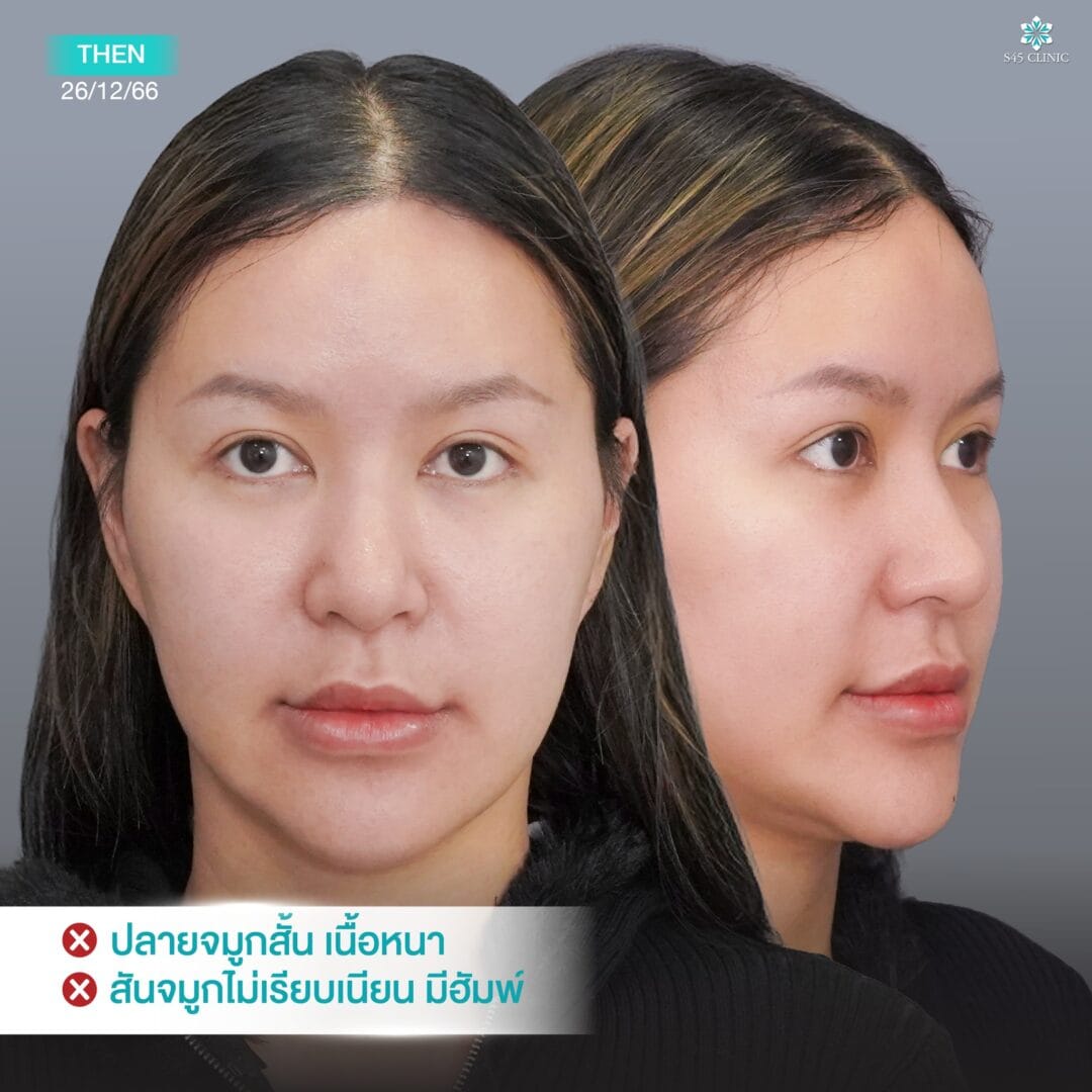 จมูกทรงตุรกี หมอจอร์เจีย