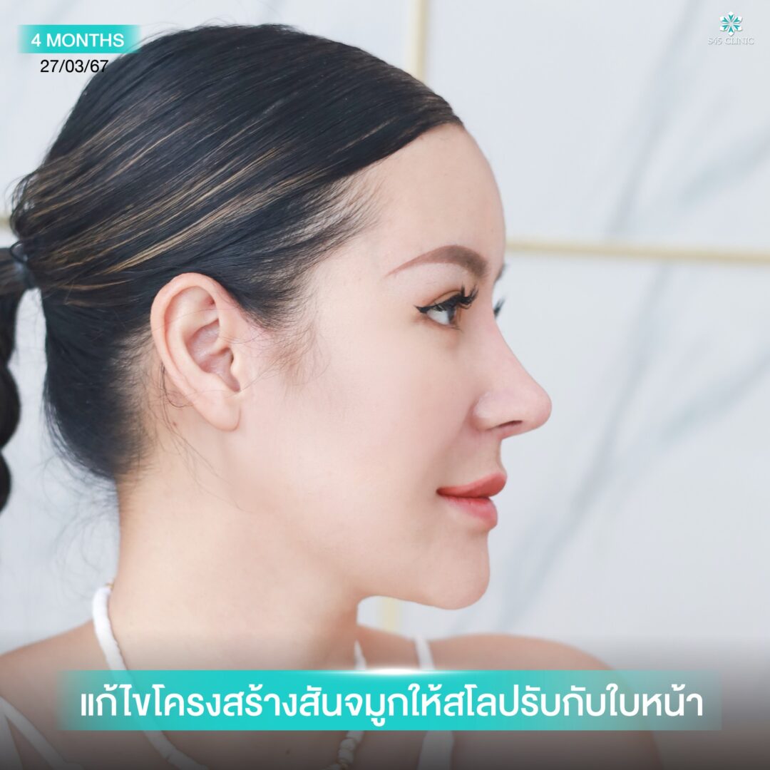 จมูกทรงตุรกี หมอจอร์เจีย