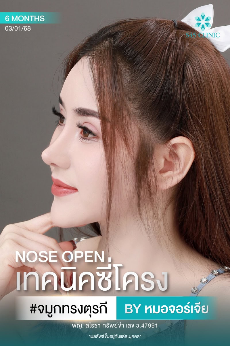 จมูกทรงตุรกี หมอจอร์เจีย