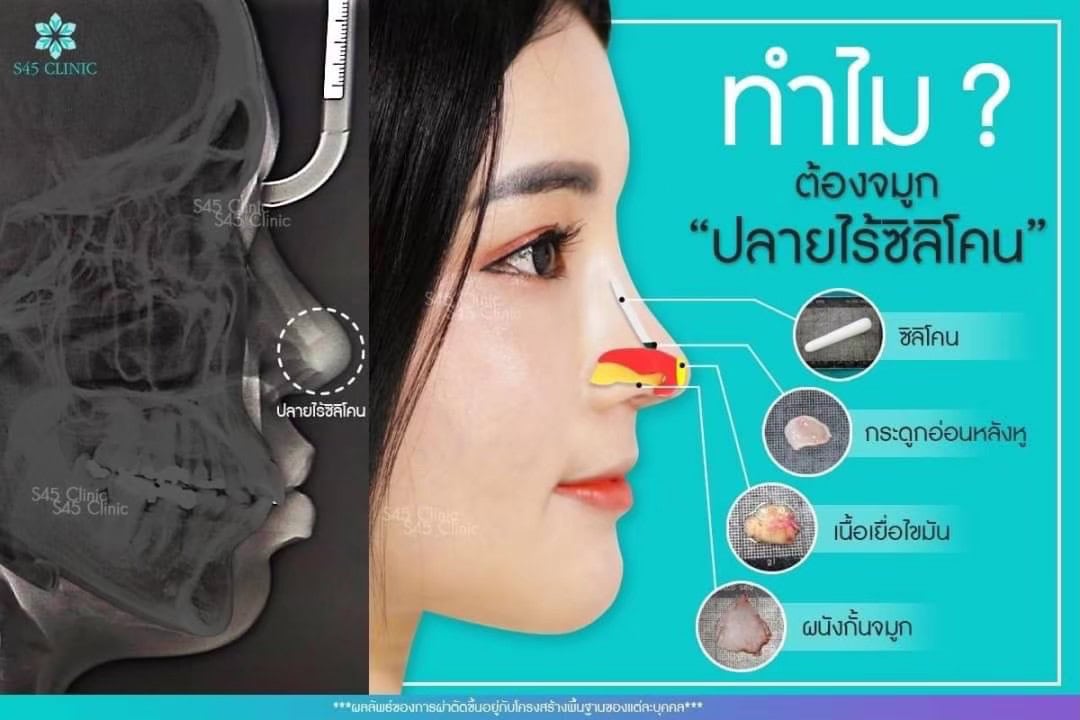 เสริมจมูก เนื้อเยื่อรองปลาย