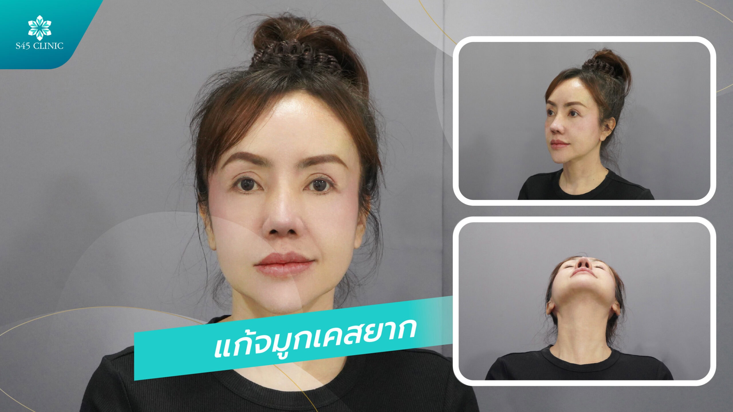 แก้จมูก เคสยาก