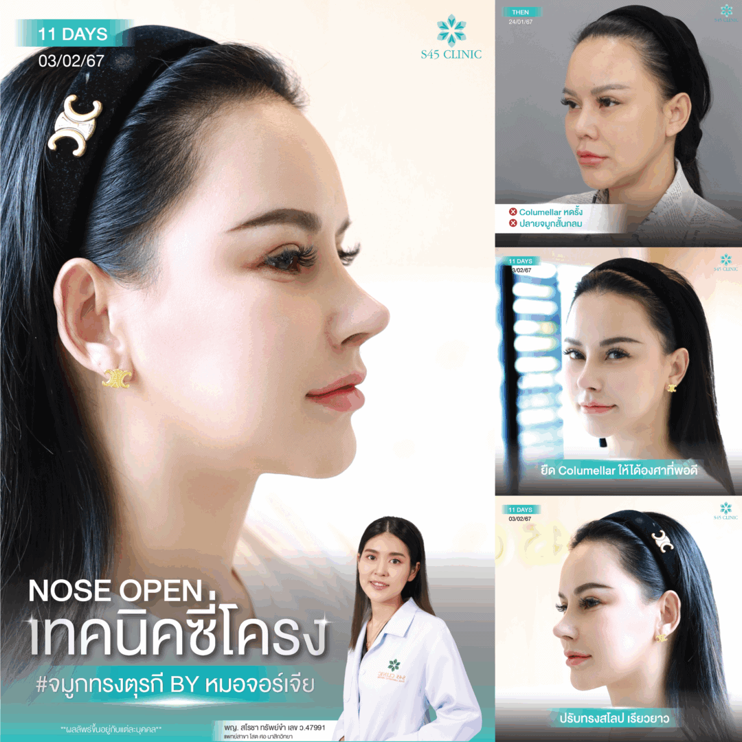 ทรงจมูกตุรกี หมอจอร์เจีย S45 Clinic