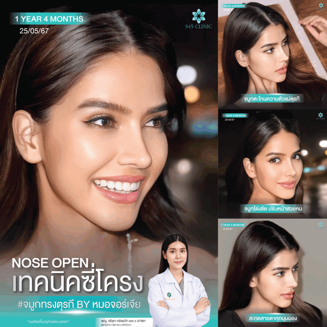 ทรงจมูกตุรกี หมอจอร์เจีย S45 Clinic