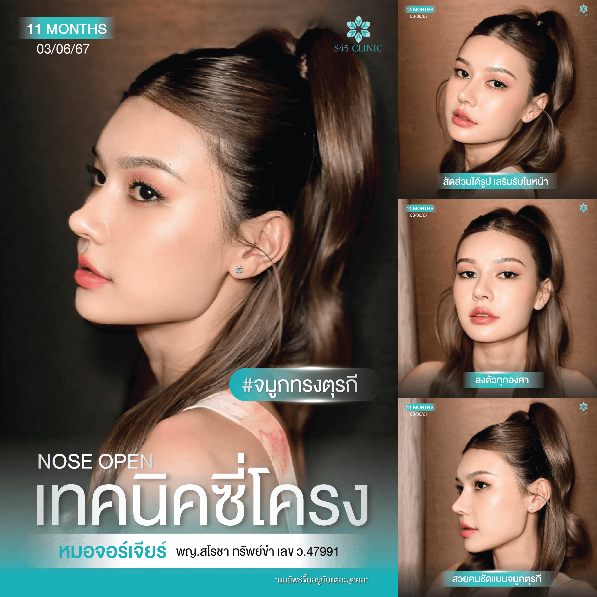 ทรงจมูกตุรกี หมอจอร์เจีย S45 Clinic