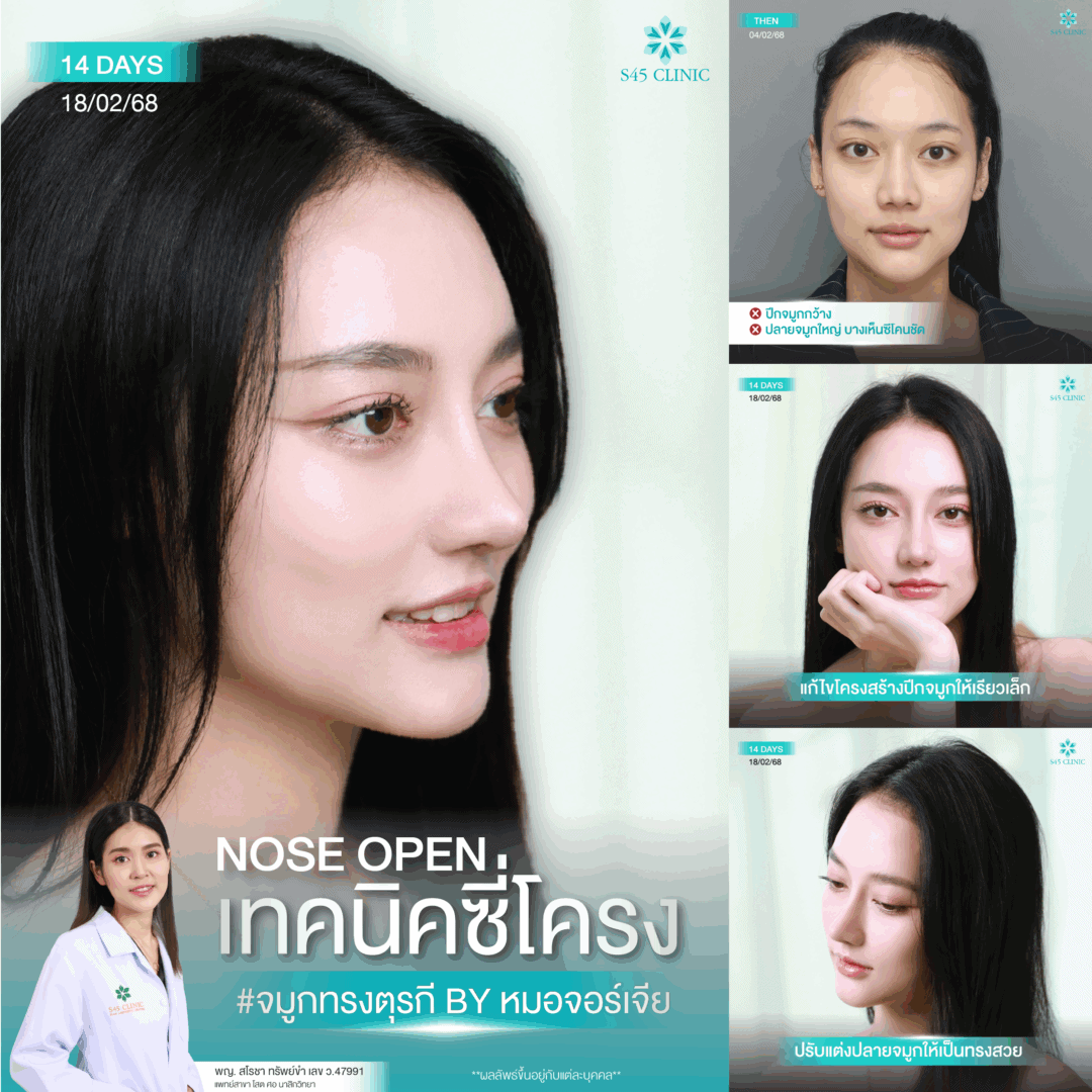 ทรงจมูกตุรกี หมอจอร์เจีย S45 Clinic